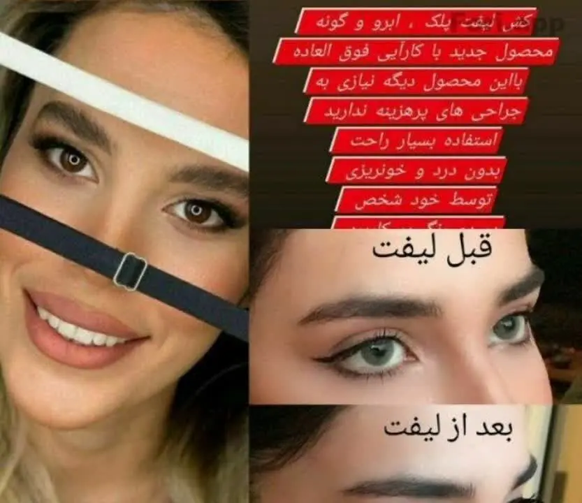 کش لیفت شقیقه 
