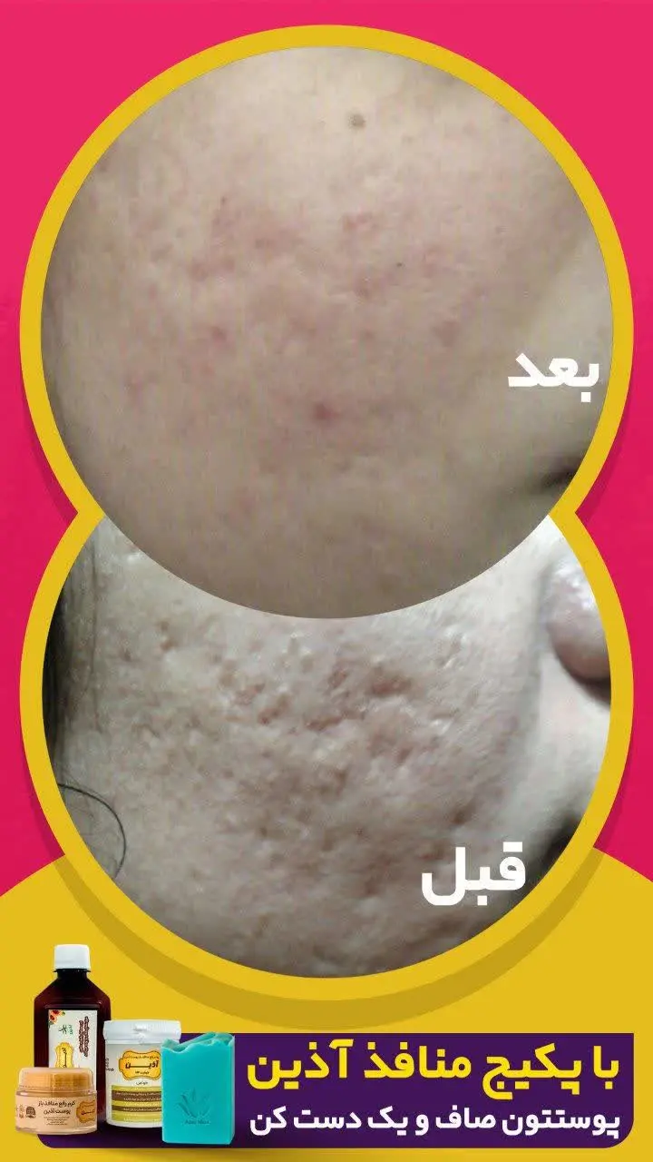 پکیج منافذ، پک منافذ اذینه👏🏻