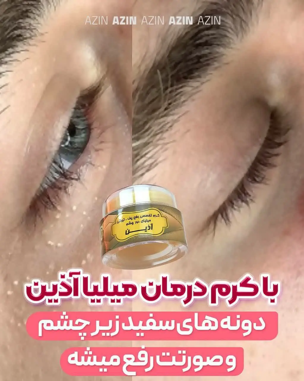 🍃 #کرم_تخصصی_درمان_میلیا_دور_چشمها_و_صورت
